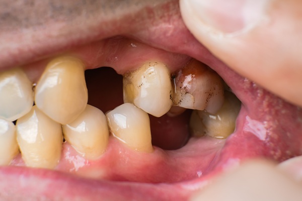 Restorative Options For Missing Teeth